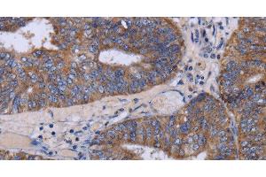 Immunohistochemistry of paraffin-embedded Human colon cancer tissue using MT3 Polyclonal Antibody at dilution 1:50 (MT3 anticorps)