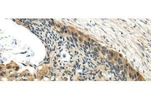 Immunohistochemistry of paraffin-embedded Human esophagus cancer using UBL4A Polyclonal Antibody at dilution of 1/40