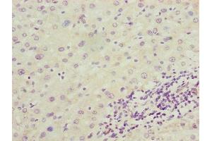 Immunohistochemistry of paraffin-embedded human liver cancer using ABIN7143865 at dilution of 1:100