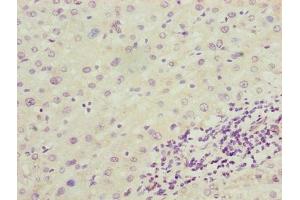 Immunohistochemistry of paraffin-embedded human liver cancer using ABIN7143865 at dilution of 1:100 (ENO1 anticorps  (AA 2-428))