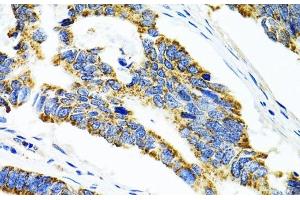 Immunohistochemistry of paraffin-embedded Human colon carcinoma using CYP1A1 Polyclonal Antibody at dilution of 1:100 (40x lens).