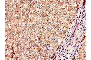 Immunohistochemistry of paraffin-embedded human liver cancer using ABIN7148300 at dilution of 1:100 (COMMD1 anticorps  (AA 2-190))