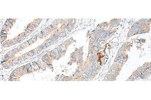 Immunohistochemistry of paraffin-embedded Human colorectal cancer tissue using GARNL3 Polyclonal Antibody at dilution of 1:60(x200) (GARNL3 anticorps)