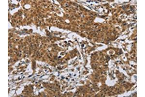 The image on the left is immunohistochemistry of paraffin-embedded Human gastric cancer tissue using ABIN7191086(IL31 Antibody) at dilution 1/20, on the right is treated with synthetic peptide. (IL-31 anticorps)