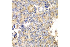 Immunohistochemistry of paraffin-embedded human prostate cancer using PICK1 antibody at dilution of 1:100 (x40 lens). (PICK1 anticorps)