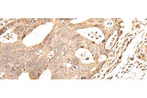 Immunohistochemistry of paraffin-embedded Human gastric cancer tissue using GRAP Polyclonal Antibody at dilution of 1:40(x200) (GRAP anticorps)
