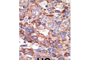 Formalin-fixed and paraffin-embedded human cancer tissue reacted with the primary antibody, which was peroxidase-conjugated to the secondary antibody, followed by DAB staining.