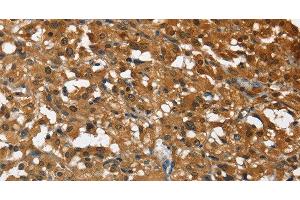 Immunohistochemistry of paraffin-embedded Human thyroid cancer tissue using DRAK2 Polyclonal Antibody at dilution 1:40 (DRAK2 anticorps)