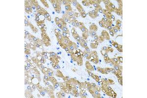 Immunohistochemistry of paraffin-embedded human liver injury using TOB2 antibody at dilution of 1:100 (x40 lens). (TOB2 anticorps)