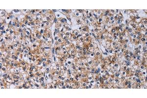 Immunohistochemistry of paraffin-embedded Human prostate cancer using CA4 Polyclonal Antibody at dilution of 1:30 (CA4 anticorps)