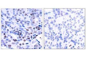 Immunohistochemical analysis of paraffin-embedded human breast carcinoma tissue using NF-κB p105/p50 (Ab-337) antibody (E021017). (NFKB1 anticorps)