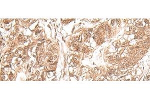 Immunohistochemistry of paraffin-embedded Human gastric cancer tissue using USP16 Polyclonal Antibody at dilution of 1:25(x200) (USP16 anticorps)