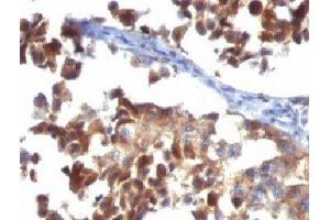 Formalin-fixed, paraffin-embedded human melanoma stained with LAMP3 antibody (LAMP3/968)