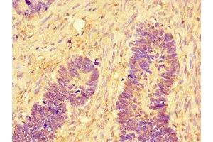 Immunohistochemistry of paraffin-embedded human ovarian cancer using ABIN7160009 at dilution of 1:100