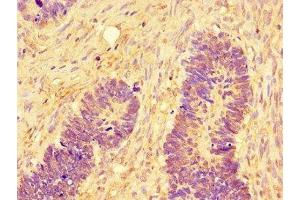 Immunohistochemistry of paraffin-embedded human ovarian cancer using ABIN7160009 at dilution of 1:100 (JNK anticorps  (AA 5-300))