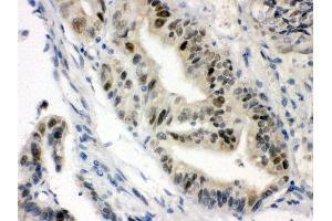 Anti-VDR Picoband antibody, IHC(P) IHC(P): Human Intestinal Cancer Tissue