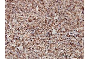 Immunoperoxidase of monoclonal antibody to STIM1 on formalin-fixed paraffin-embedded human malignant lymphoma, diffuse large B.