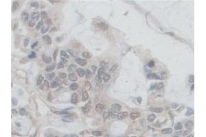 Detection of NOX5 in Human Stomach cancer Tissue using Polyclonal Antibody to Nicotinamide Adenine Dinucleotide Phosphate Oxidase 5 (NOX5)