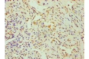 Immunohistochemistry of paraffin-embedded human breast cancer using ABIN7148700 at dilution of 1:100
