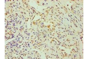 Immunohistochemistry of paraffin-embedded human breast cancer using ABIN7148700 at dilution of 1:100 (CRY1 anticorps  (AA 507-586))