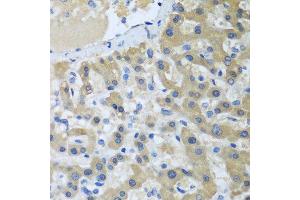 Immunohistochemistry of paraffin-embedded human liver cancer using XPC antibody at dilution of 1:100 (40x lens). (XPC anticorps)
