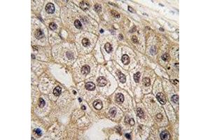 IHC analysis of FFPE human hepatocarcinoma tissue stained with PERK antibody