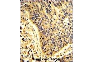 Formalin-fixed and paraffin-embedded human lung carcinoma with MyoGEF Antibody (N-term), which was peroxidase-conjugated to the secondary antibody, followed by DAB staining. (PLEKHG6 anticorps  (N-Term))