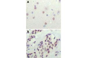 Immunohistochemical analysis of paraffin-embedded human cerebra (A) and breast carcinoma tissue (B), showing nuclear location. (NCOR1 anticorps)