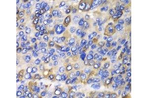 Immunohistochemistry of paraffin-embedded Human liver cancer using CES1 Polyclonal Antibody at dilution of 1:100 (40x lens). (CES1 anticorps)