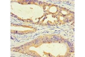 Immunohistochemistry of paraffin-embedded human colon cancer using ABIN7150645 at dilution of 1:100 (DMRTA1 anticorps  (AA 201-504))