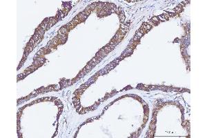 IHC analysis of Carbonic Anhydrase 9/CA9 using anti-Carbonic Anhydrase 9/CA9 antibody (ABIN7600076). (CA9 anticorps  (AA 146-414))