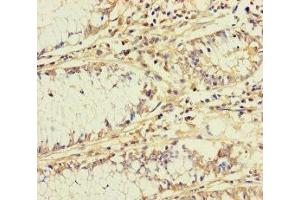 Immunohistochemistry of paraffin-embedded human colon cancer using ABIN7145543 at dilution of 1:100 (BCMO1 anticorps  (AA 1-300))