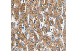 ABIN6266594 at 1/100 staining human liver carcinoma tissue sections by IHC-P. (MMP19 anticorps  (N-Term))