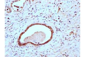 IHC image of ABIN7147892 diluted at 1:200 and staining in paraffin-embedded human gastric cancer performed on a Leica BondTM system. (Claudin 18 anticorps  (AA 196-261))