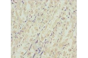 Immunohistochemistry of paraffin-embedded human gastric cancer using ABIN7144963 at dilution of 1:100