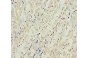 Immunohistochemistry of paraffin-embedded human gastric cancer using ABIN7144963 at dilution of 1:100 (DDX11 anticorps  (AA 1-220))