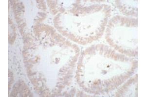 IHC staining of human rectal cancer tissue, diluted at 1:200.