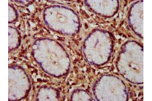 IHC image of ABIN7154840 diluted at 1:150 and staining in paraffin-embedded human gastric cancer performed on a Leica BondTM system.