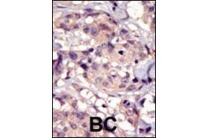 Formalin-fixed and paraffin-embedded human cancer tissue reacted with the primary antibody, which was peroxidase-conjugated to the secondary antibody, followed by DAB staining.