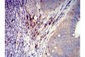 Immunohistochemical analysis of paraffin-embedded rectum cancer tissues using CD319 mouse mAb with DAB staining.