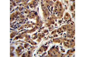 AKT antibody immunohistochemistry analysis in formalin fixed and paraffin embedded human breast carcinoma