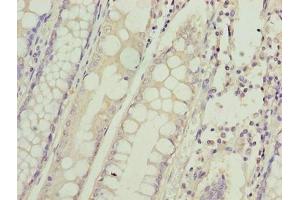 Immunohistochemistry of paraffin-embedded human colon cancer using ABIN7155160 at dilution of 1:100 (HIGD1B anticorps  (AA 1-29))