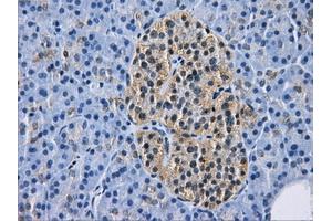 Immunohistochemical staining of paraffin-embedded Adenocarcinoma of breast tissue using anti-HDAC10 mouse monoclonal antibody. (HDAC10 anticorps)