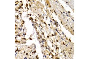 Immunohistochemistry of paraffin-embedded human colon damage using TFDP1 antibody at dilution of 1:200 (400x lens). (DP1 anticorps)