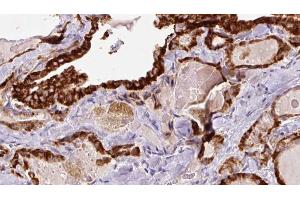 ABIN6267189 at 1/100 staining Human thyroid cancer tissue by IHC-P. (SYN1 anticorps  (pSer605))