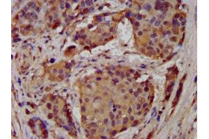 IHC image of ABIN7143000 diluted at 1:300 and staining in paraffin-embedded human pancreatic cancer performed on a Leica BondTM system. (ACCN1 anticorps  (AA 197-345))