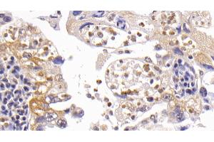 Detection of Bcl2L in Human Lung cancer Tissue using Polyclonal Antibody to B-Cell CLL/Lymphoma 2 Like Protein (Bcl2L)