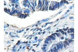 Immunohistochemical analysis of paraffin-embedded human colon carcinoma showing cytoplasmic staining with ACAD9 polyclonal antibody  at a 1 : 100 dilution. (ACAD9 anticorps  (AA 1464-1642))