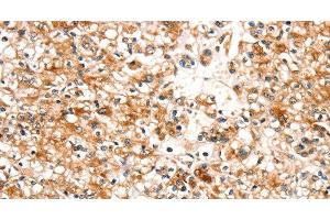 Immunohistochemistry of paraffin-embedded Human prostate cancer tissue using SLC25A12 Polyclonal Antibody at dilution 1:30