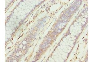 Immunohistochemistry of paraffin-embedded human colon cancer using ABIN7176126 at dilution of 1:100